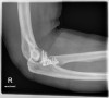 SPORK, NICO - 22.03.1976 - 05.08.2022 - Rö Ellenbogen rechts - 14:55:11 - ELBOW